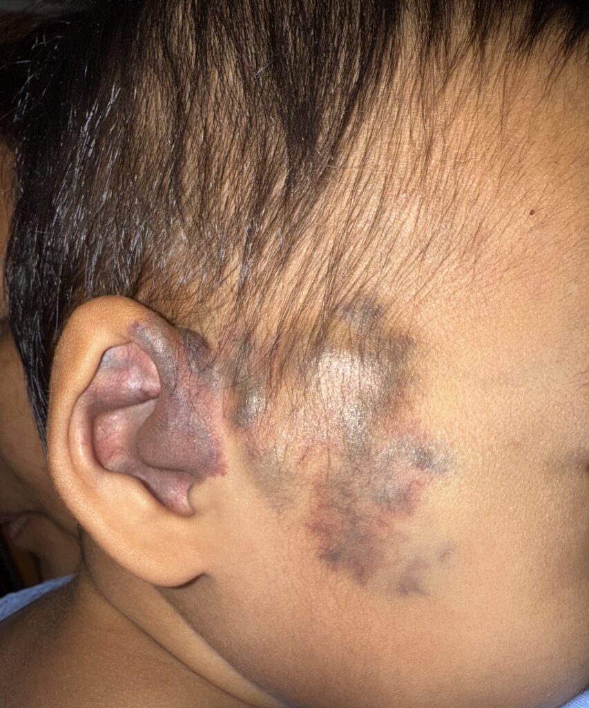 Venous Malformation (รูปที่1)
