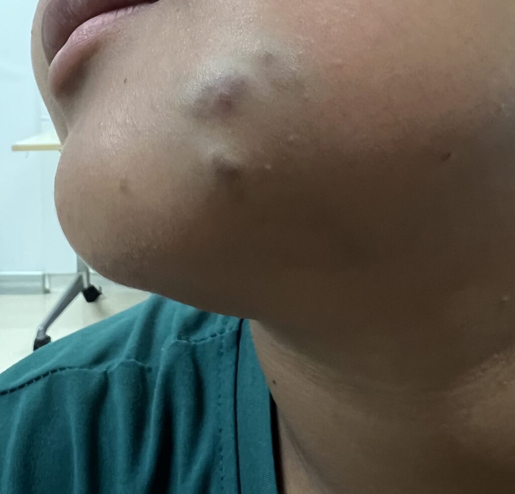 Venous Malformation (รูปที่2)