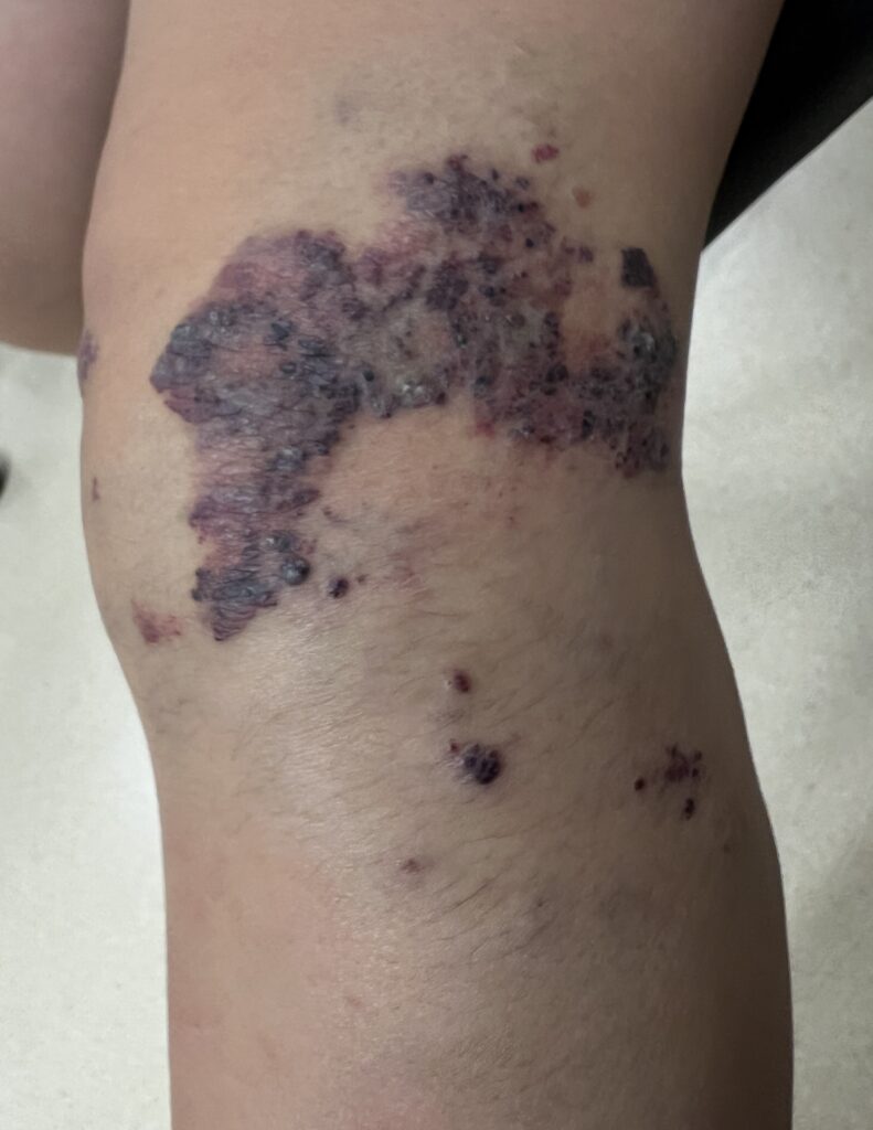 Venous Malformation (รูปที่3)