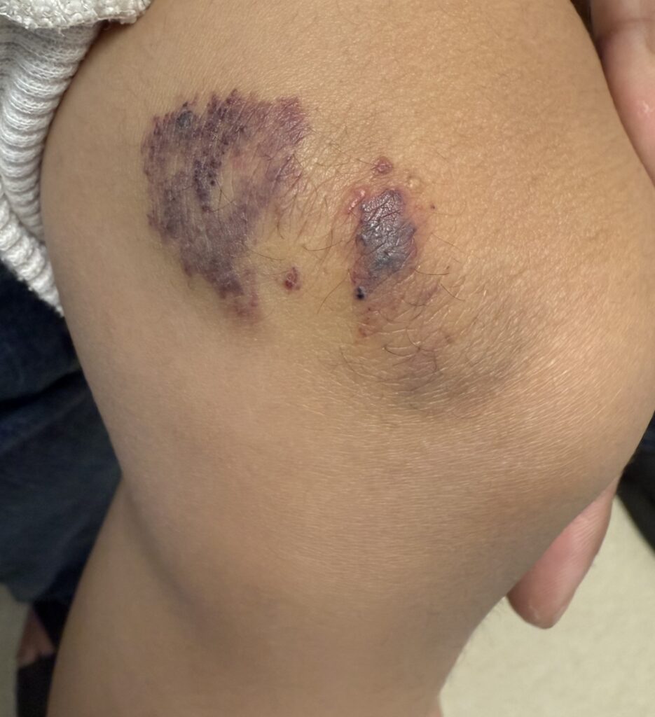Venous Malformation (รูปที่4)